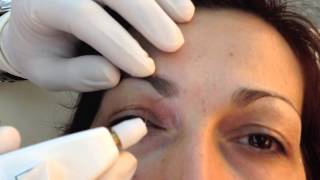 Not Surgical aesthetic blepharoplasty with PLEXR [upl. by Neelloc]