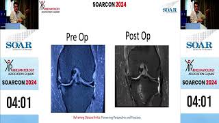 Dr Prathmesh JainAhmedabadInternal Knee Derangement in OARAGRheumatology Association of Gujarat [upl. by Aistek514]