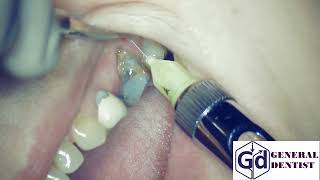 Infiltration anesthesia for extraction 26 tooth and implantation area 2526 [upl. by Clements341]