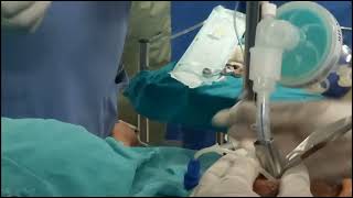 Endotracheal intubation with intubating LMA [upl. by Bent283]