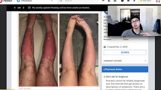 TAKING HUMIRA OR SUFFERING PSORIASIS WATCH THIS [upl. by Areht]