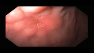 Gastric Ulcer Following Gastrostomy Tube Removal [upl. by Hodge]