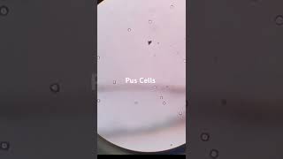 Pus Cells in Urine microscopy urine saleemlabtechnician puscells shorts ytshorts [upl. by Jodi]