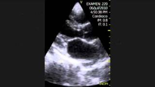 VSCAN Echocardiography The Normal Exam Parasternal LongAxis View [upl. by Rhpotsirhc505]