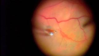 25 Gauge Vitrectomy for Macular Pucker ERM [upl. by Trix]