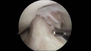 Torn Meniscus Arthroscopic Surgery [upl. by Defant]