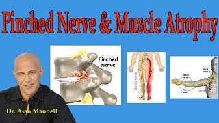 Pinched Nerve and Muscle Atrophy What You Should Understand  Dr Mandell [upl. by Neerroc]