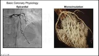 Coronary Microvascular Dysfunction in Contemporary Practice Demystifying Angina w Open Coronaries [upl. by Robins317]