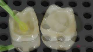 CEMENTACIÓN ZIRCONIA RELYX ULTIMATE [upl. by Inaffets]