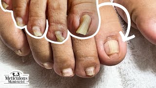 Incredible Pincer Toenail Makeover A Transformation [upl. by Atsira]