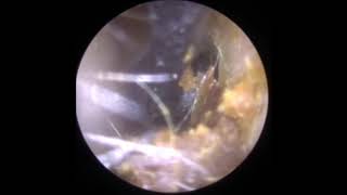 Gentle ear wax removal with Jobson Horne Probe [upl. by Ynnek]