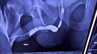 Retrograde Urography RGU for diagnosis of Urethral Stricture [upl. by Alliscirp]