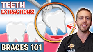 BRACES 101 Tooth Extractions For Braces  Treatment Minute Talk [upl. by Stover523]