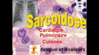 Sarcoidose pulmonaire articulaire renale hepatique cutanée ophtalmologique [upl. by Orgalim]