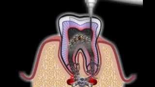 Wurzelbehandlung beim Zahnarzt [upl. by Ottie]