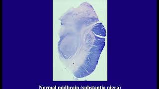 Pathology of Dementia Degenerative and Spinal Cord Diseases [upl. by Anelas]