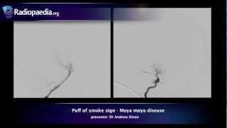 Puff of smoke sign  radiology video tutorial angiography [upl. by Berck]