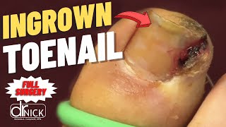 Extreme Closeup Ingrown Toenail Removal  Dr Nick Campitelli [upl. by Ebaj]