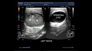 Ultrasound Video showing a mass in testis with torsion and an epididymal cyst [upl. by Caras]