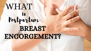 Postpartum Breast Engorgement information and tips for newborn breastfeeding [upl. by Aiekan]