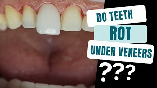 The Truth Behind Teeth Rot under Veneers [upl. by Ieluuk]