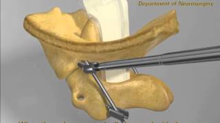 Posterior Reduction of Atlantoaxial Dislocation and Basilar Invagination [upl. by Nadnarb]