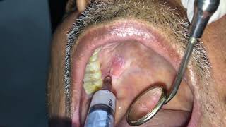 Intralesional Injection in Oral Lichen Planus Dr Ankit Goel Hapur [upl. by Schumer]