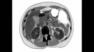 Duodenal HematomaPerforation [upl. by Lahcsap]