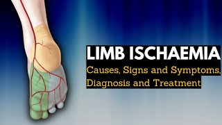 Limb Ischaemia  Causes Signs and Symptoms Diagnosis and Treatment [upl. by Nylasor]