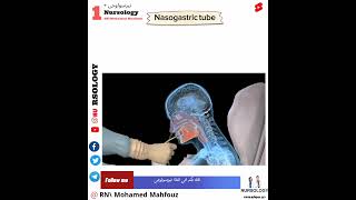 NasogastricTubeكيفية تركيب أنبوب المعده [upl. by Miehar804]