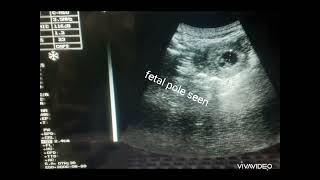 Early gestational sac ultrasound 7week with ampwithout fetal pole [upl. by Remmus]