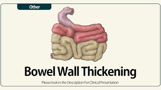 Linear EUS Bowel Wall Thickening [upl. by Ydassac]