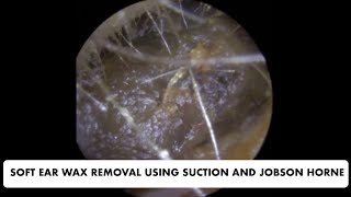 SOFT EAR WAX REMOVAL USING SUCTION AND JOBSON HORNE  Ep 31 [upl. by Ameerak859]