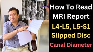 Lower Back MRI L4 L5 Herniated Disc MRI Stenosis of the Spine How to know Lumbar canal Diameter [upl. by Aneelak829]