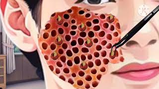 remove maggots bee stings so they become infected removemakeup maggotbsf trypophobia [upl. by Renraw]