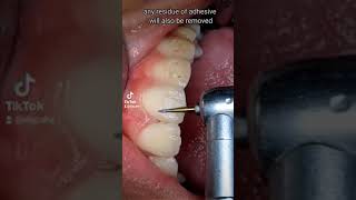 Polishing teeth after bracket removal  Braces Removal [upl. by Pugh]