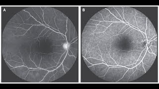 Vaskulitis der Retina bei Takayasu Arteriitis [upl. by Toole]