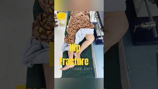 Hip Fracture Surgery  Intertrochanteric Fracture Femur  Proximal Femur Nail  Dr Prateek Joshi [upl. by Nyllewell]