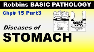 Chp15 Part3 Robbins Basic Patho  Diseases of STOMACH  Dr Asif Lectures [upl. by Samalla]