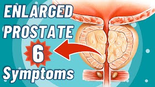 Enlarged Prostate 6 SERIOUS Symptoms You Have NEVER Heard Of  Benign Prostatic Hyperplasia [upl. by Iliram]