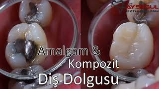 Kompozit Dolgu amp Amalgam Dolgu Kıyaslama  Diş Dolguları [upl. by Trescott291]