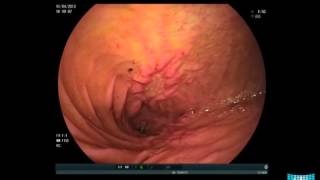 Obstructive Small Bowel Crohns Disease in Balloon Enteroscopy [upl. by Pelage705]