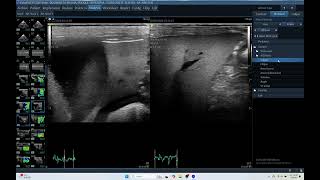 IQ 174 LIVER HEPATOMA LT LOBE ECHOCARDIOGRAPHY ECHOPAC ANALYSIS HEPATOMA PDH CORTISOL 89 [upl. by Anpas305]