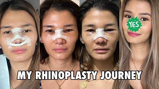 MY RHINOPLASTY JOURNEY  Was it worth it  Jen Barangan [upl. by Essie]