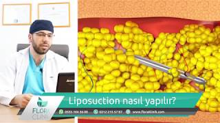 Liposuction Nasıl Yapılır Ne Kadar Yağ Alınır [upl. by Aylmer334]