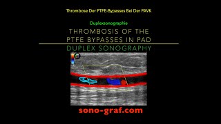 Duplexsonographie  Thrombose Des Bypasses Bei Der Peripheren Arteriellen Verschlusskrankheit [upl. by Aisiram]