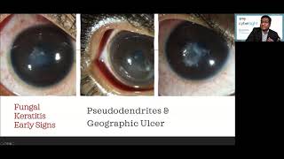 Lecture Microbial Keratitis Update for General Ophthalmologists [upl. by Latouche426]