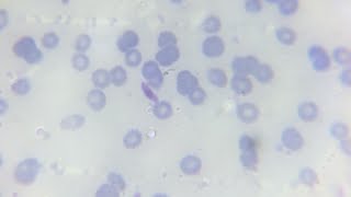 Malaria parasite plasmodium falciperum gametocyte in thick and thin blood smear in microscopic slide [upl. by Hegyera14]