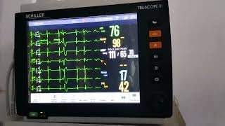 case of Ventricular Bigeminy changing to Trigeminy and Quadrigeminy [upl. by Blackwell230]