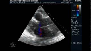 VEGETACION VALVULAR AORTICA en varon de 71 a Dr Pedro Guillermo Bustos 19 Agosto 2011wmv [upl. by Labaw172]